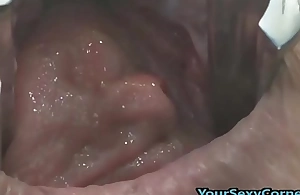 Extreme anal and slit prolapse after bizarre dp